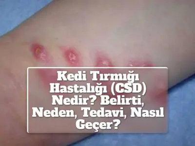 Kedi Tırmığı Hastalığı (CSD) Nedir? Belirti, Neden, Tedavi, Nasıl Geçer?